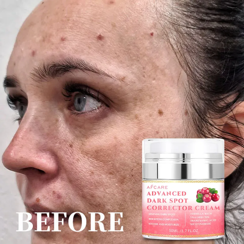 

Arbutin Cream Lightens Dark Spots Brightens And Refines The Skin Improves The Skin Dullness Moisturizes Softens Skin Care