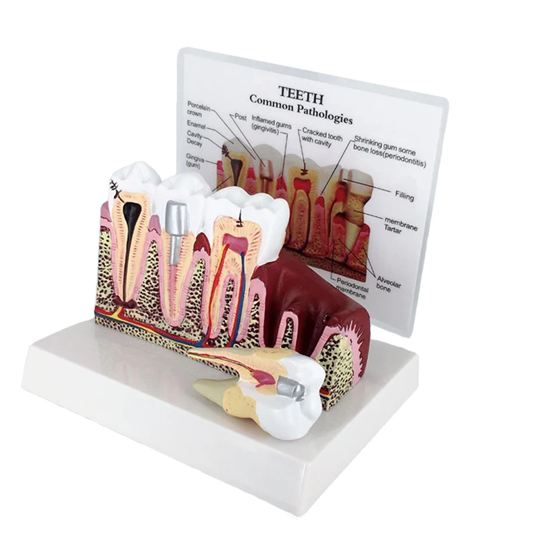 Teeth Anatomy Dental Model Teaching Study Dental Anatomical Model for Dentist Patient Education Demonstration Dentistry Products