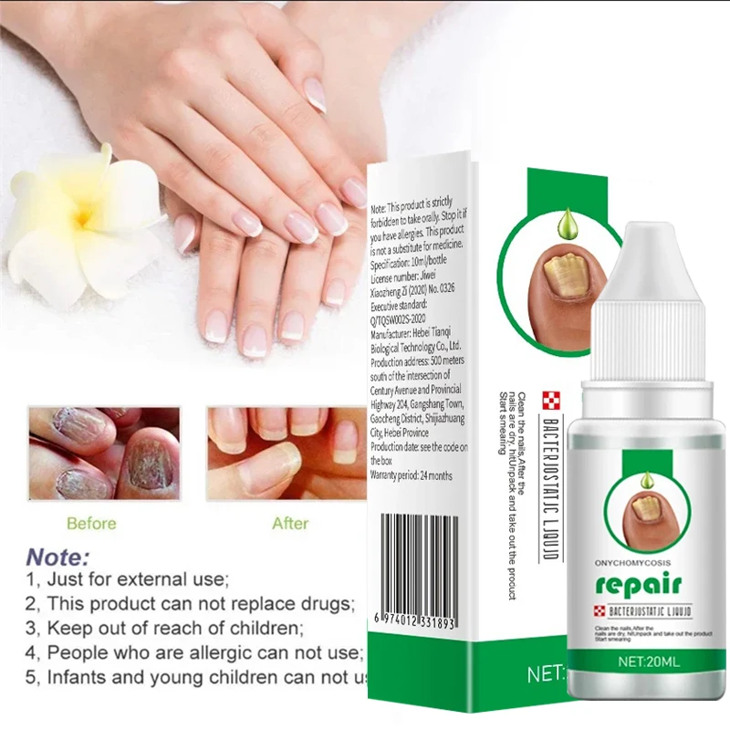 Unha fungo tratamento soro, Toe Fungal Repair Products, Mão Foot Care Remoção Gel, Anti infecção, Onicomicose Paroníquia, Novo