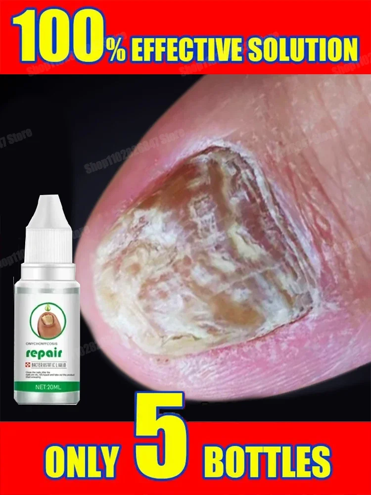 Extra Nail Fungus Treatment Serum Essence oil Feet Nails Repair Care Essence Cream Anti Infection Toe Fungal Removal