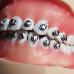 Yamei metal self-ligating brackets spherical arc dental self-ligating orthodontic brackets orthodontic Yamei ball brackets