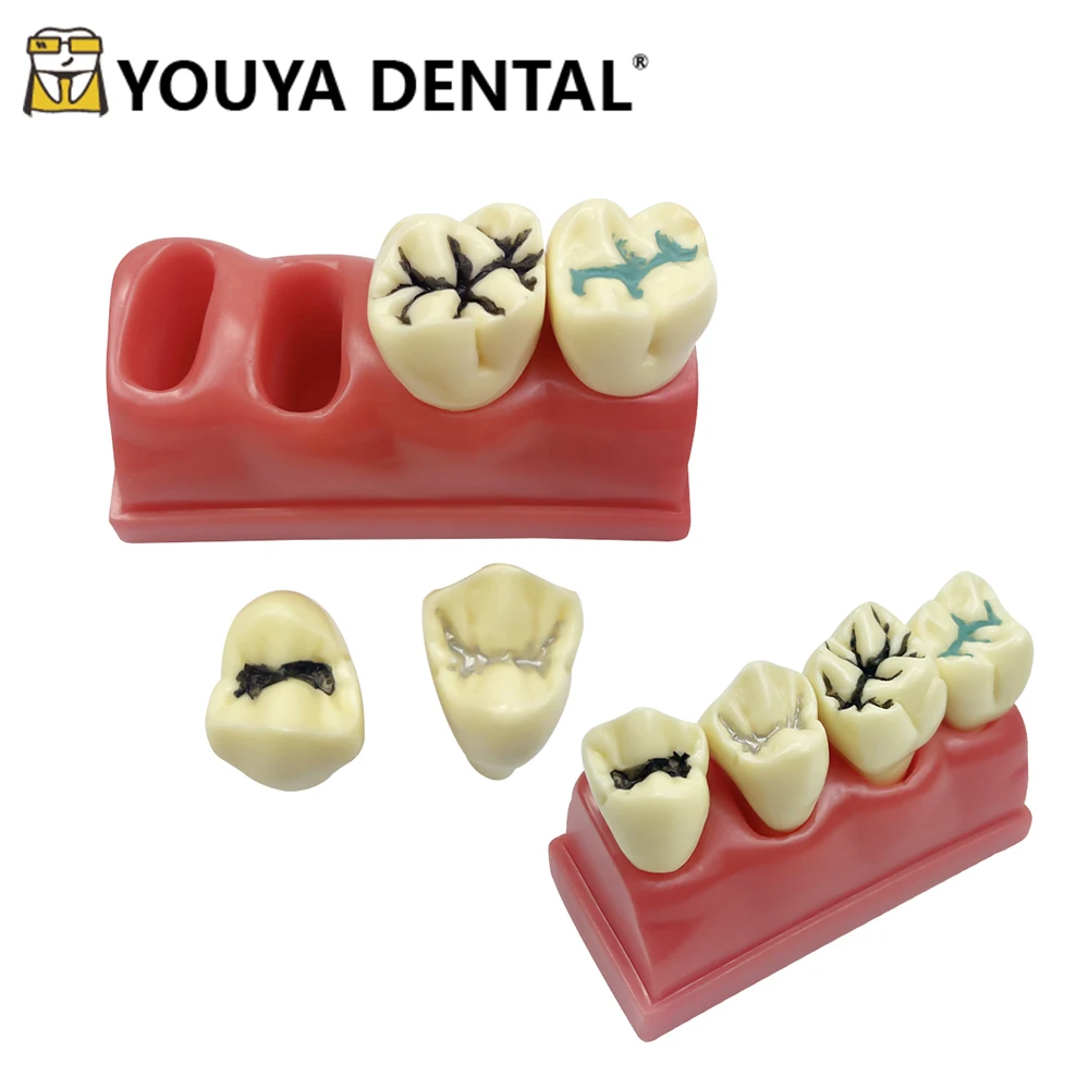 Dental Teeth Model 4 Times Pit And Fissure Sealant Model Pathological Models for Dental Technician Teaching Studying