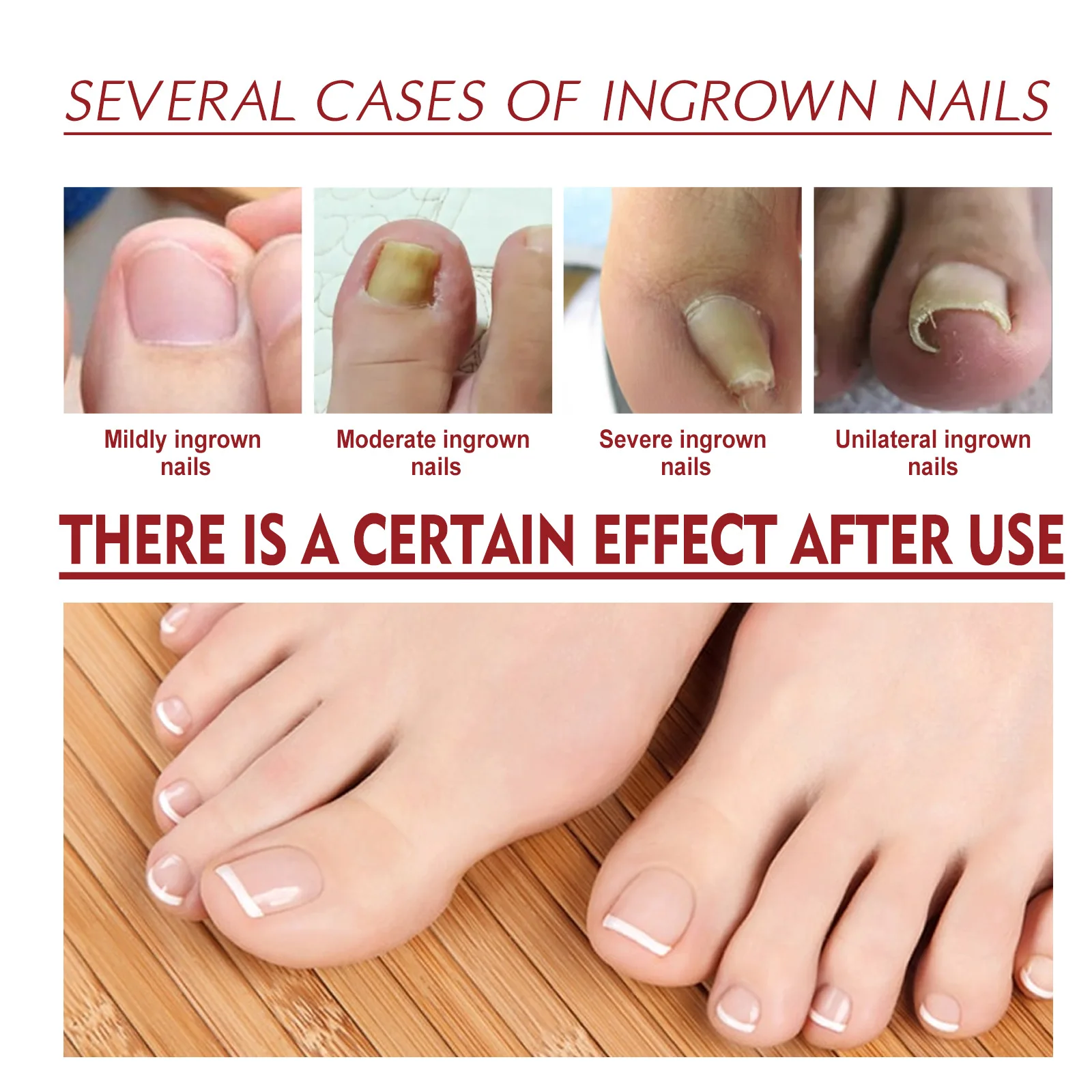 발톱무좀 10ML Ingrown Toenail Drops Ingrown Toenail Relief Oil Portable Ingrown Toenail Removal Drops Essential Oil Solution uñas