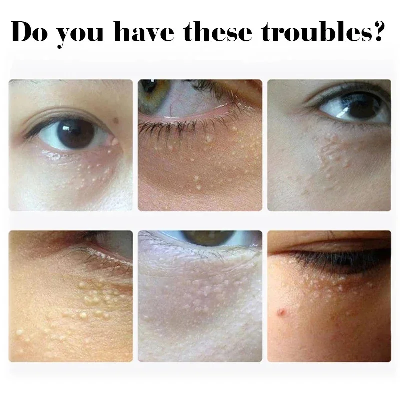 Fat Granules Remover Eye Cream Anti-Puffiness Anti Inflammatory Reduce Dark Circles Eyebags Fade Lines Moisturizing Eye Care view 4