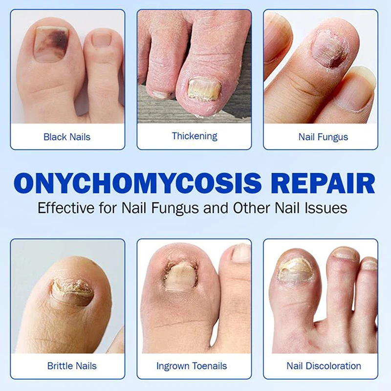 Parches para reparación de uñas, parche para hongos en las uñas de los pies, cuidado de las uñas de los pies pegajosas, pegatina de corrección encarnada, parche para tratamiento de paroniquia, 10/21 Uds.