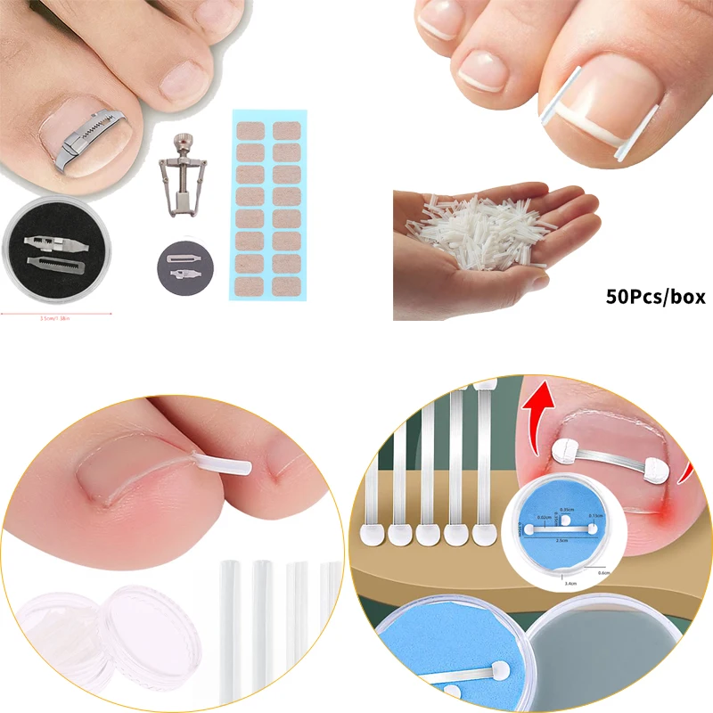 Ingrown Toenail Cor…