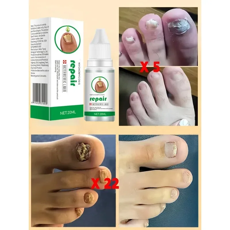 Ätherisches Öl zur Nagelspilzbehandlung, repariert Onychomykose in 7-Tage