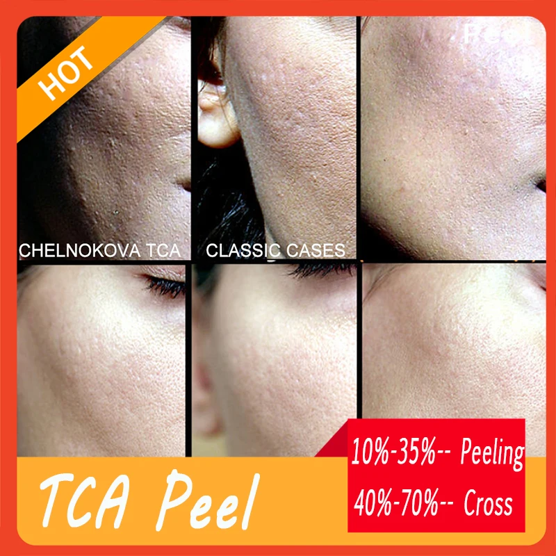 Chelnokova-ácido peeling forte tca 35 35%, 5ml, descascador de pele rápido, pé, arquivo traseiro, frete grátis