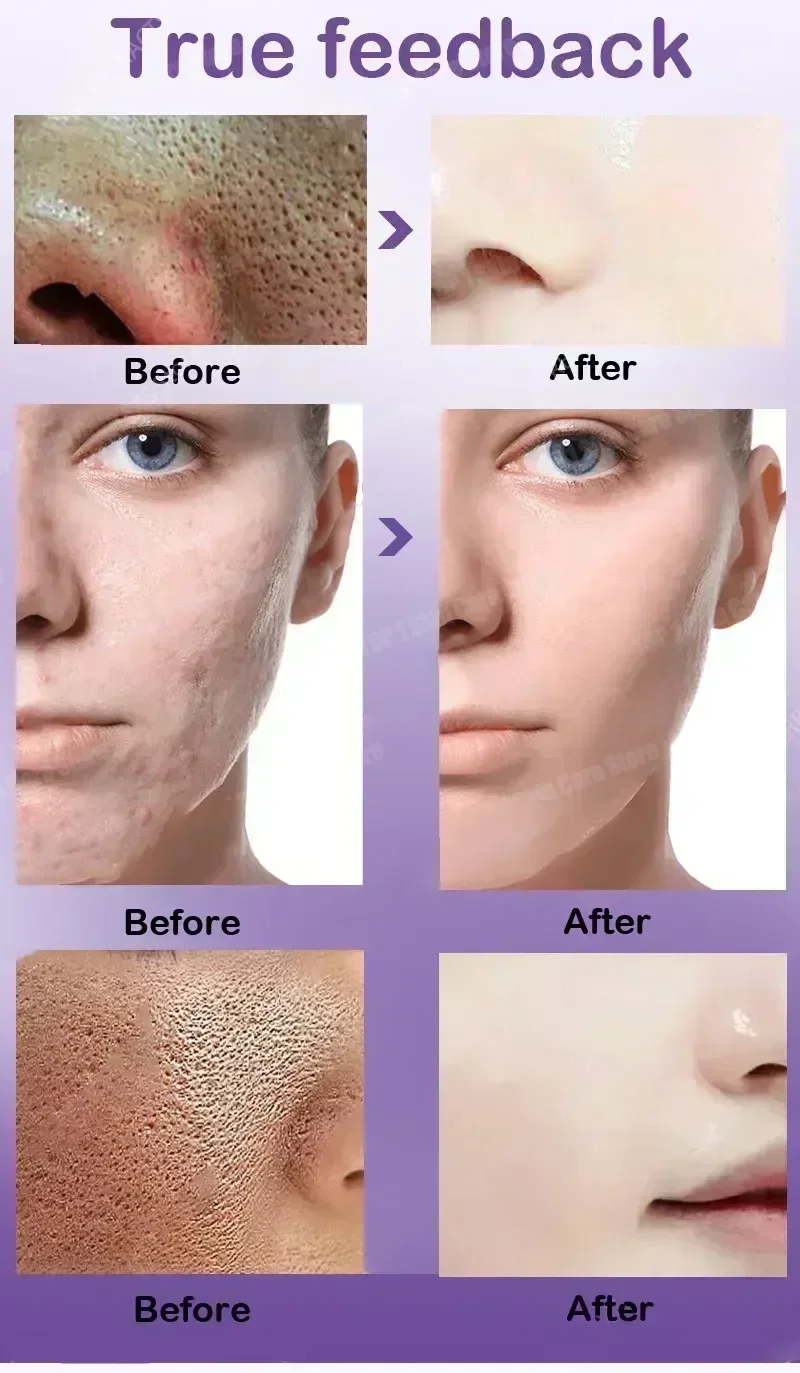 

²⁰²⁵ Pore Shrinking Facial Essence Oil Control Repair Nourishing Remove Large Pores Firming Essence Moisturizing