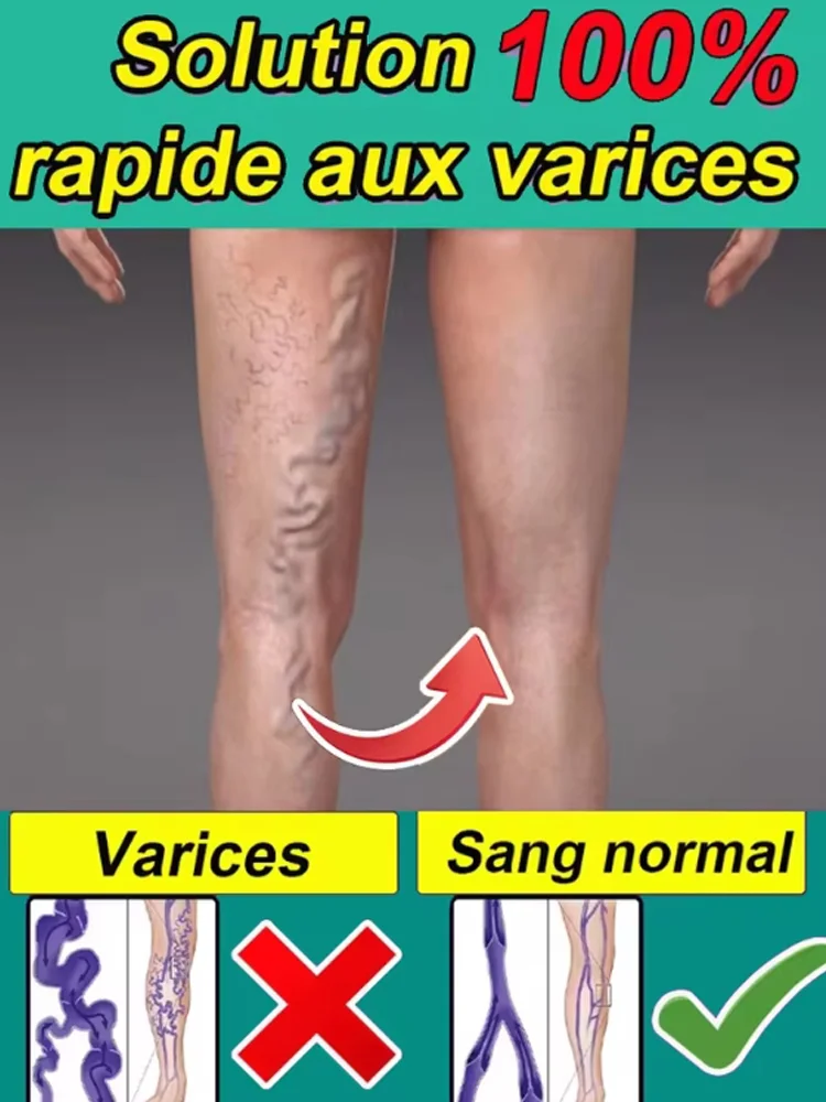 

Upgrade varicose veins laser pen, medical grade 980nm infrared therapy device, spider vein and leg blood Painless treatment with