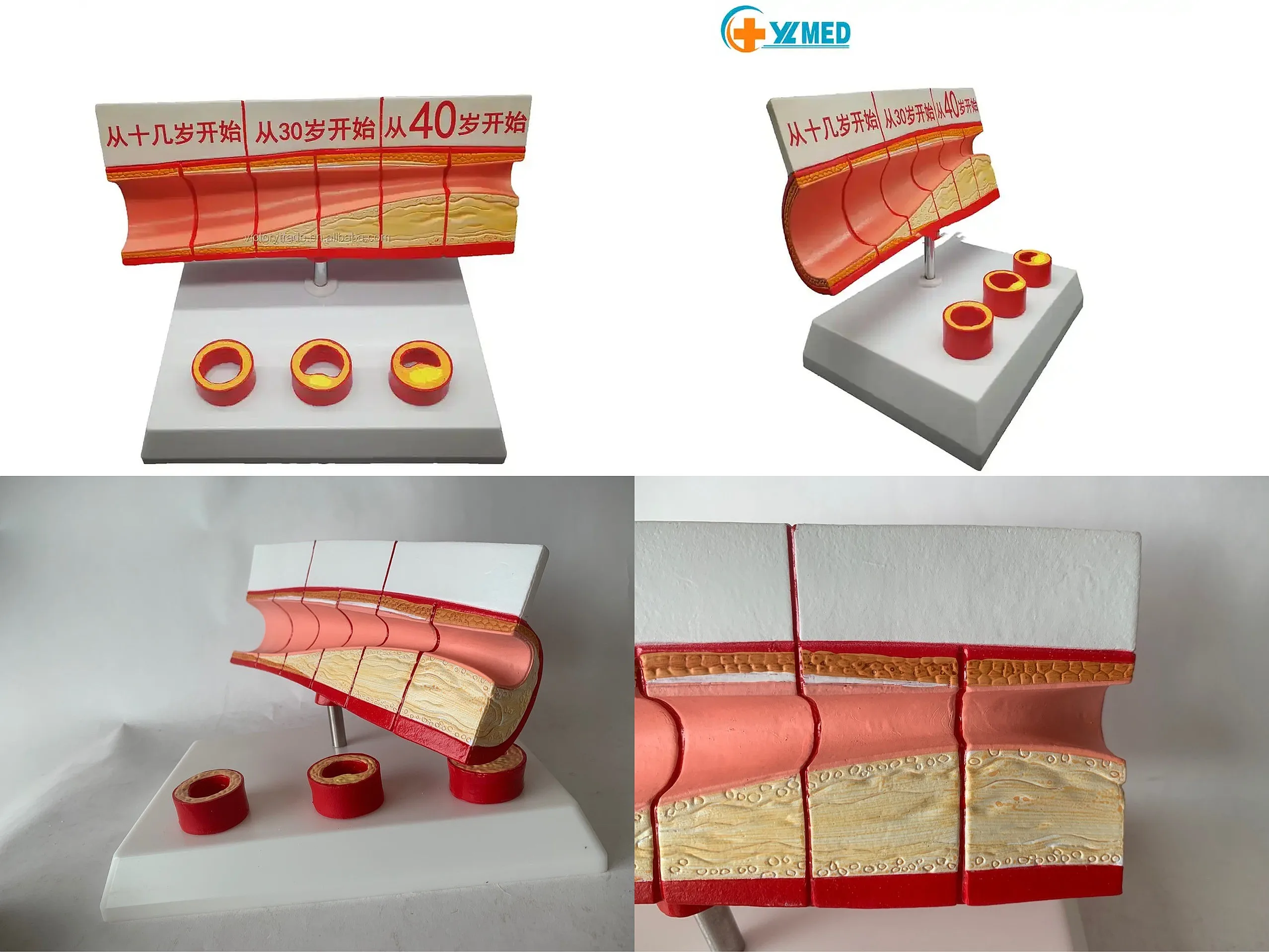 Anatomical Human Vascular Lesions & Occlusion Demonstration Model YL2-30032