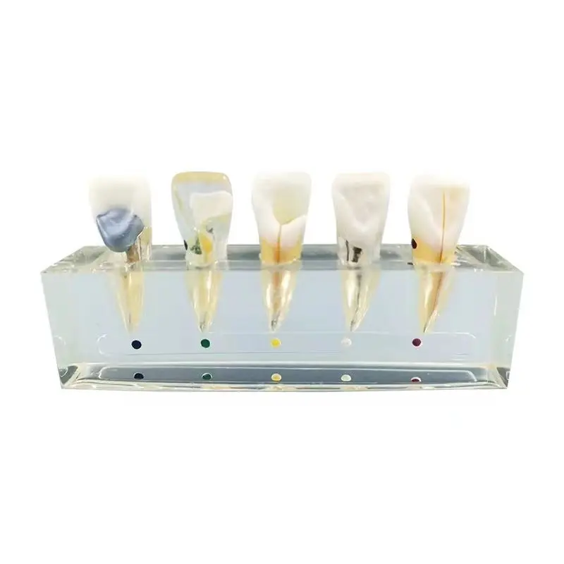 

Endodontic treatment Upper central incisor pathology Patient communication model free shipping