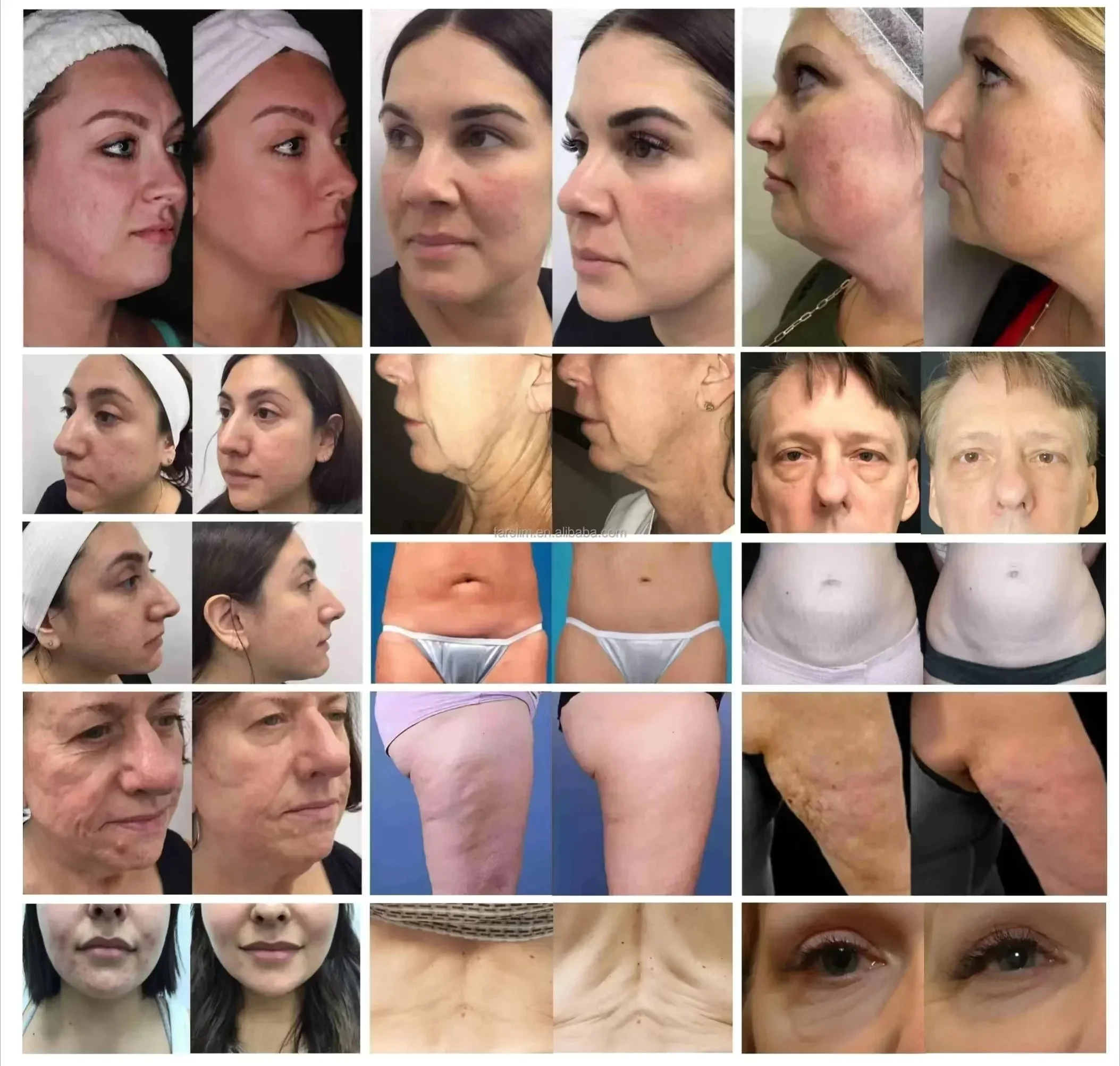 모르페우스8 2 in 1 얼굴 및 바디 시술 기계