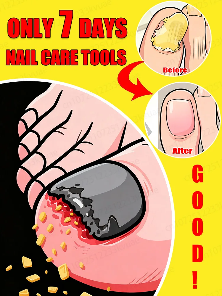 

Qᴜɪᴄᴋ Tʀᴇᴀᴛᴍᴇɴᴛ, Sᴀʏ Gᴏᴏᴅʙʏᴇ ᴛᴏ Fᴜɴɢᴀʟ Nᴀɪʟ Wᴏʀʀɪᴇs