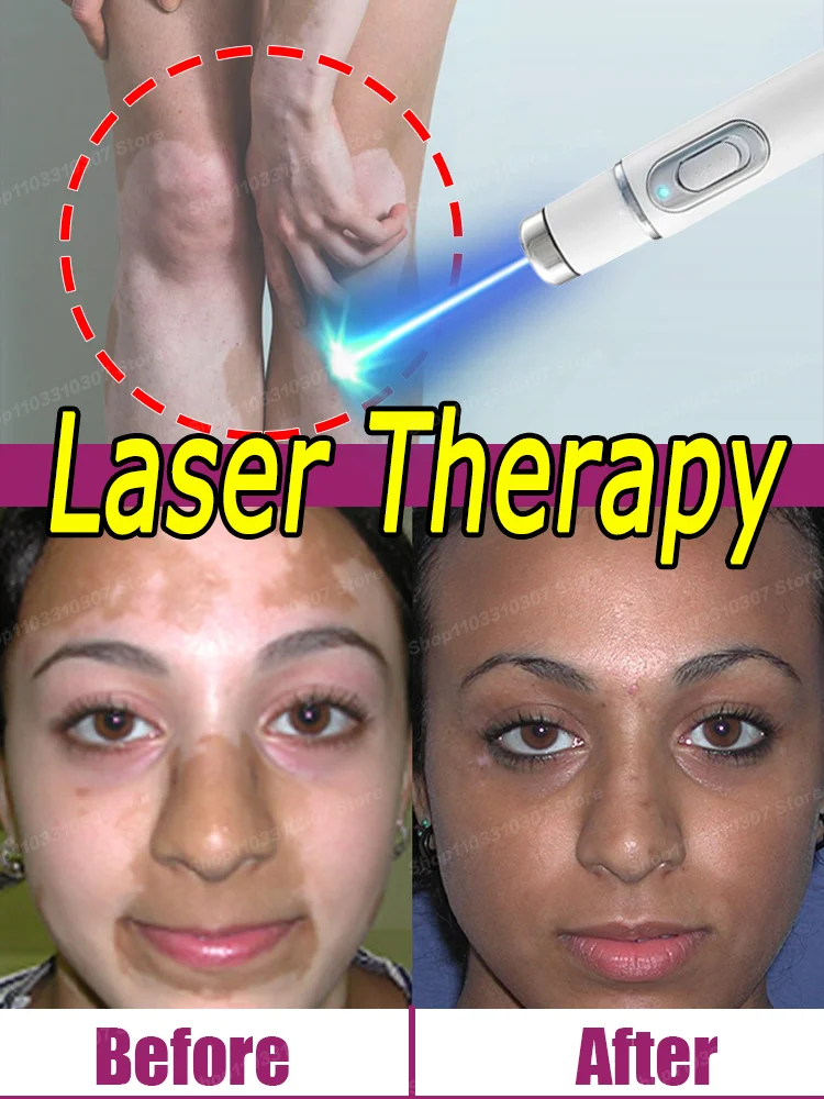 

Efficient Laser Technology Improve Vitiligo