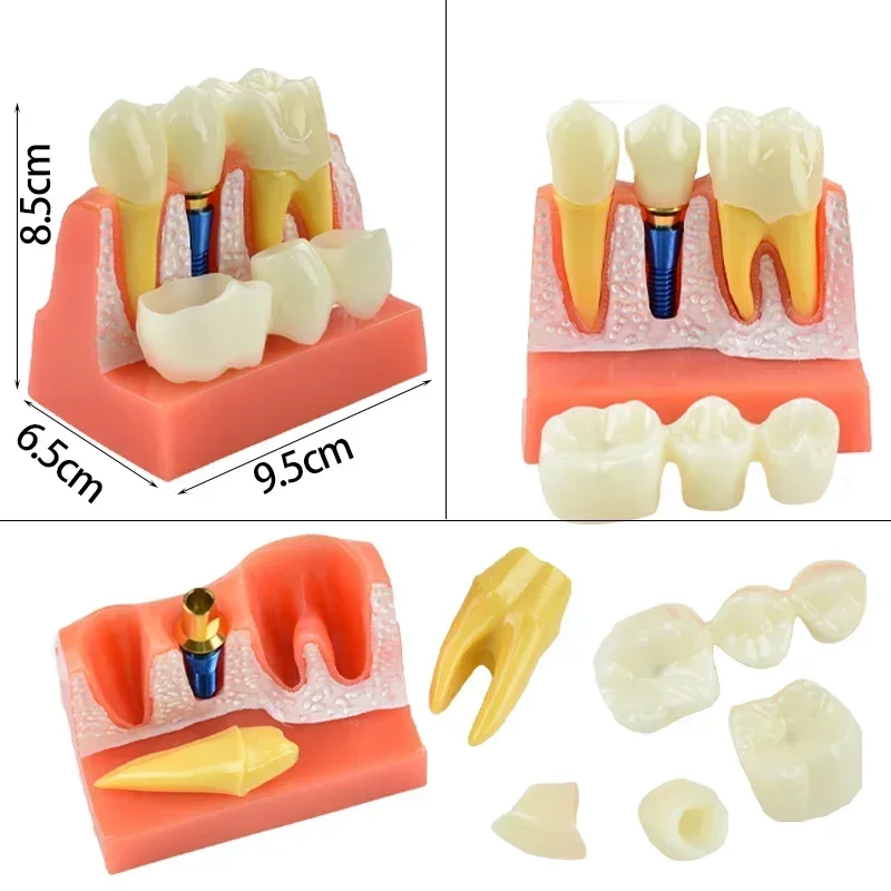 4 Times Implant Dental Teaching Model Implant Analysis Demonstration Removable Model Dentist Teaching Tools