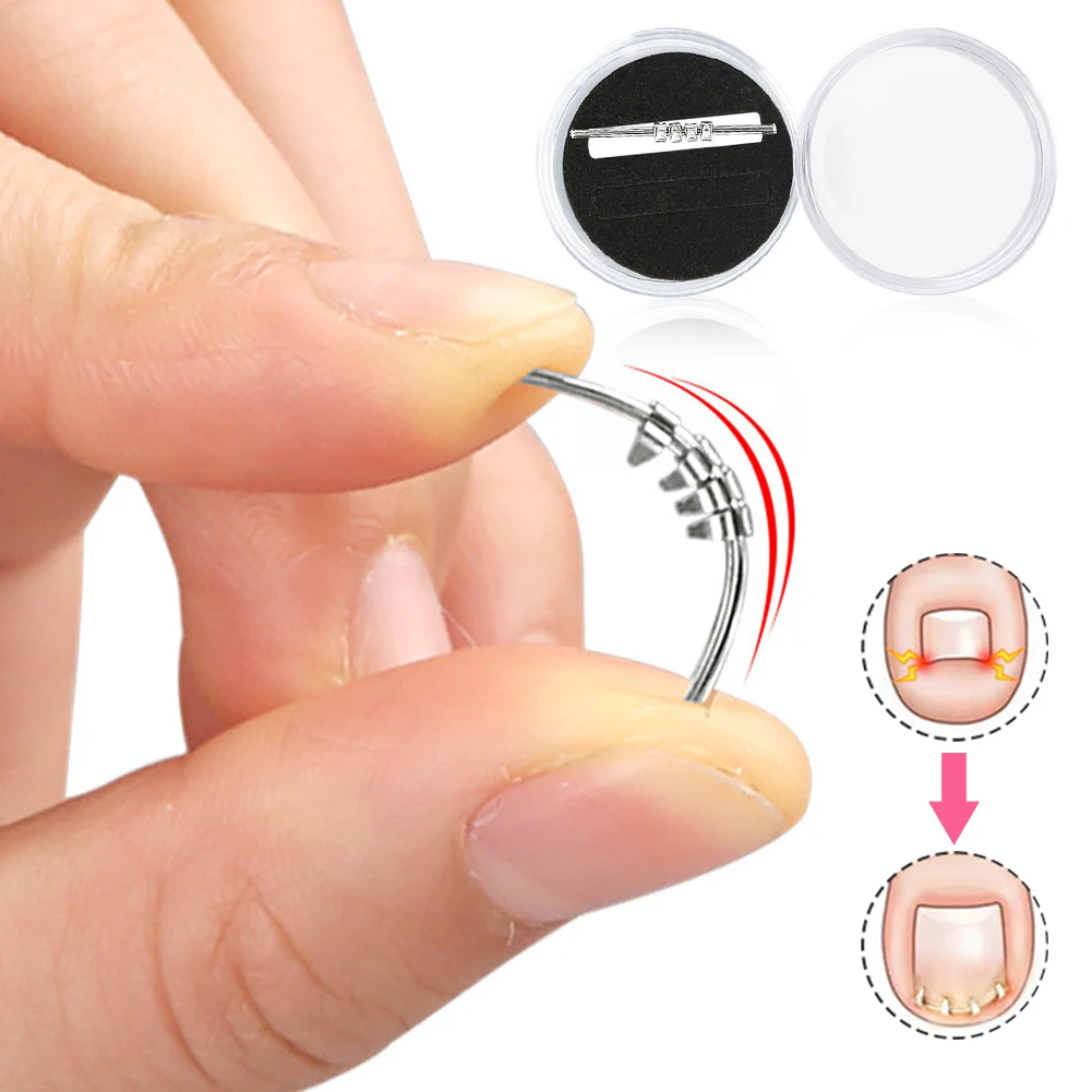 

2 Pcs Ingrown Toenail Pedicure Tool Embed Toe Nail Care Straightening Correction Clip Curved Clamp Toenails Correction Tool