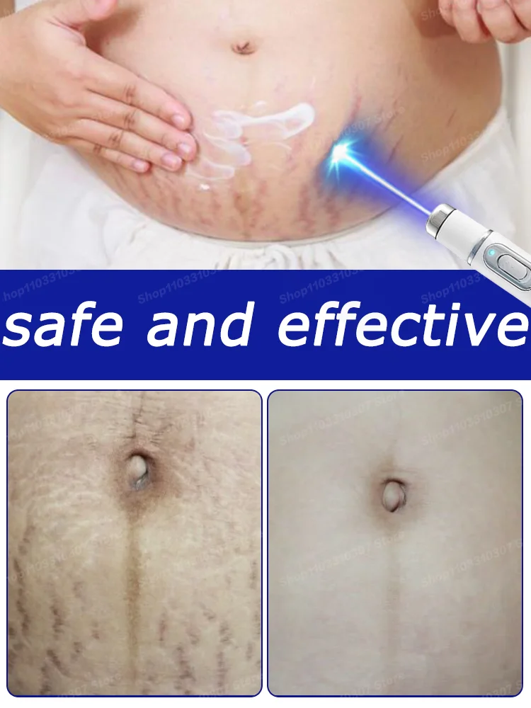 

Blu-ray Pen For Pregnancy Stretch Marks Improve