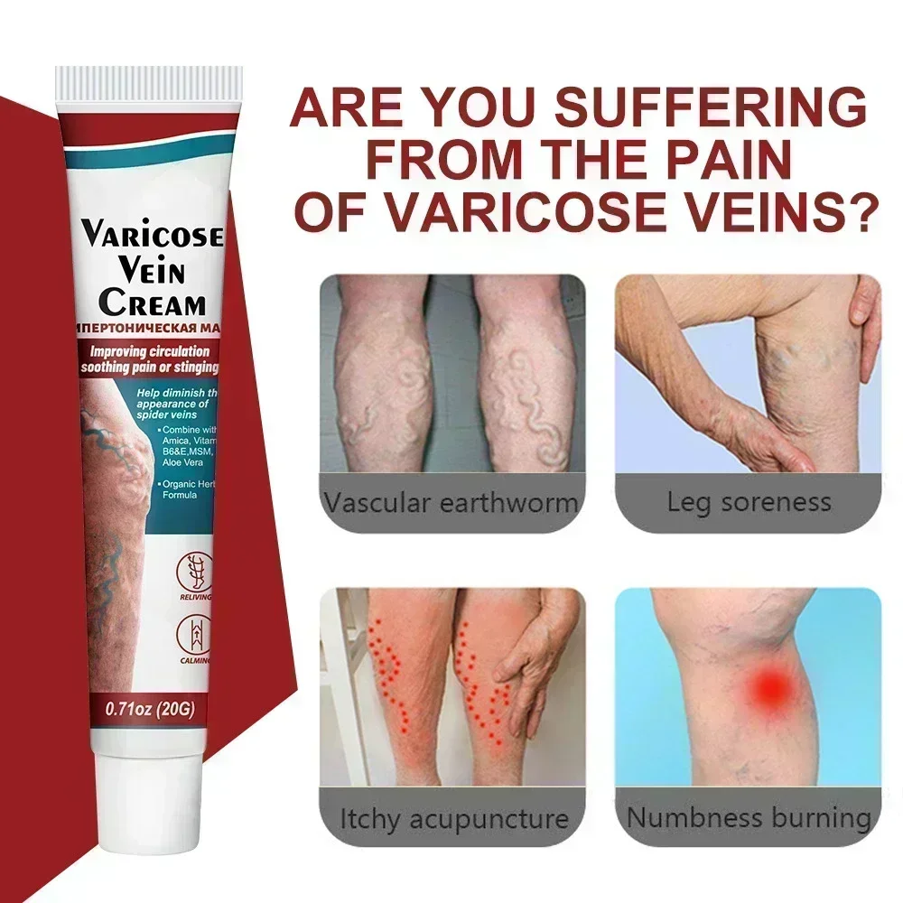 Effective Varicose Vein Relief  Ointment For Varicose Veins