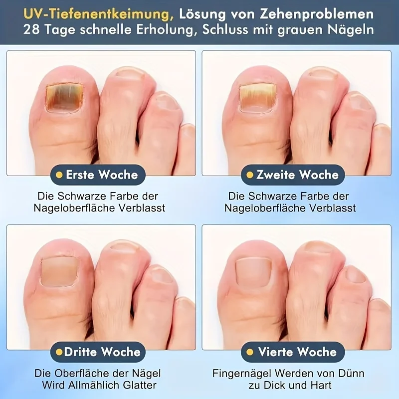 Dispositivo de luz para fungos nas unhas de 1/2/4 unidades para unhas dos pés e unhas