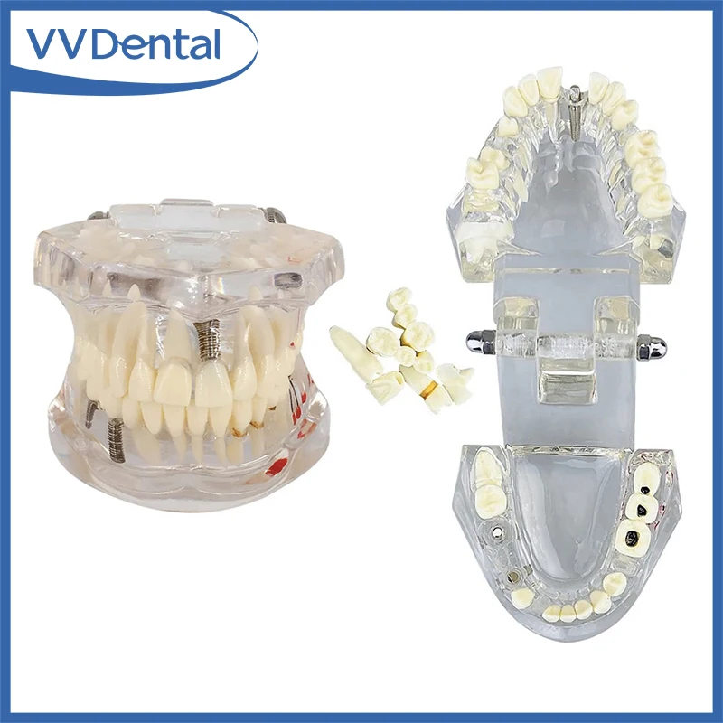 VVDental Teeth Repair Model Disease Teeth Model for Dentist Student Practice Training Studying Dentistry Tools