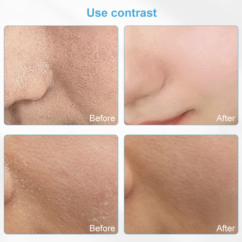 Diamond Microdermabrasion Machine Device Professional Care for Renewed Skin Deep Cleansing Exfoliating for Facial Skin Blackhead