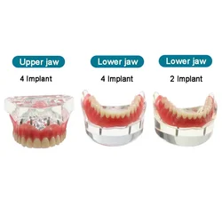 Model zębów dentystyczny z implantem overdention gorszy Model Demo żuchwy dentysta Model uczenia się studenta