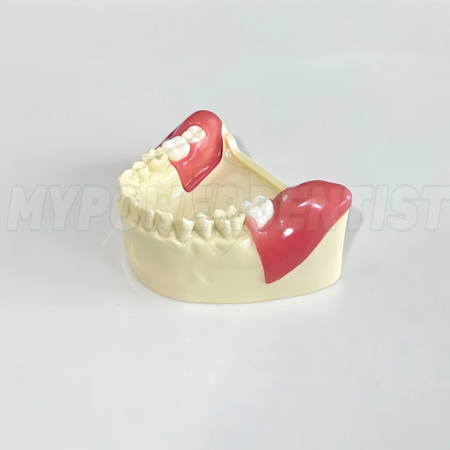 Dental Obstructed Wisdom Teeth Extraction Model Lower Soft Gingiva Wisdom Study Display Detachable Model