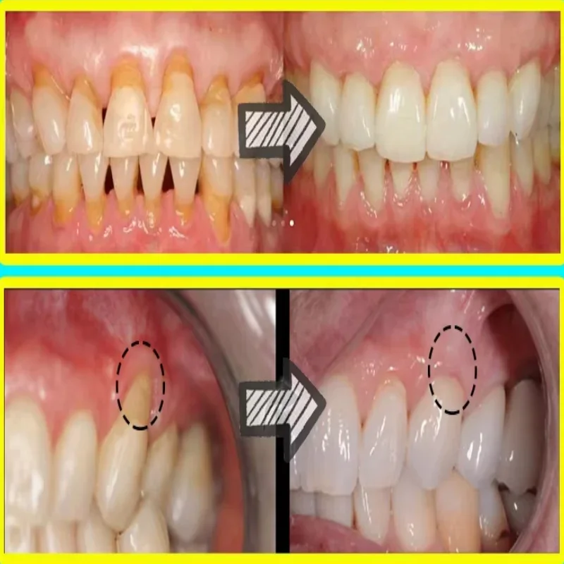 Quickly Repair Gum Serum Relieve Receding Gum Regrowth Drops Teeth Whiten Remove Yellow Plaque Stains Decay Toothache Toothpaste