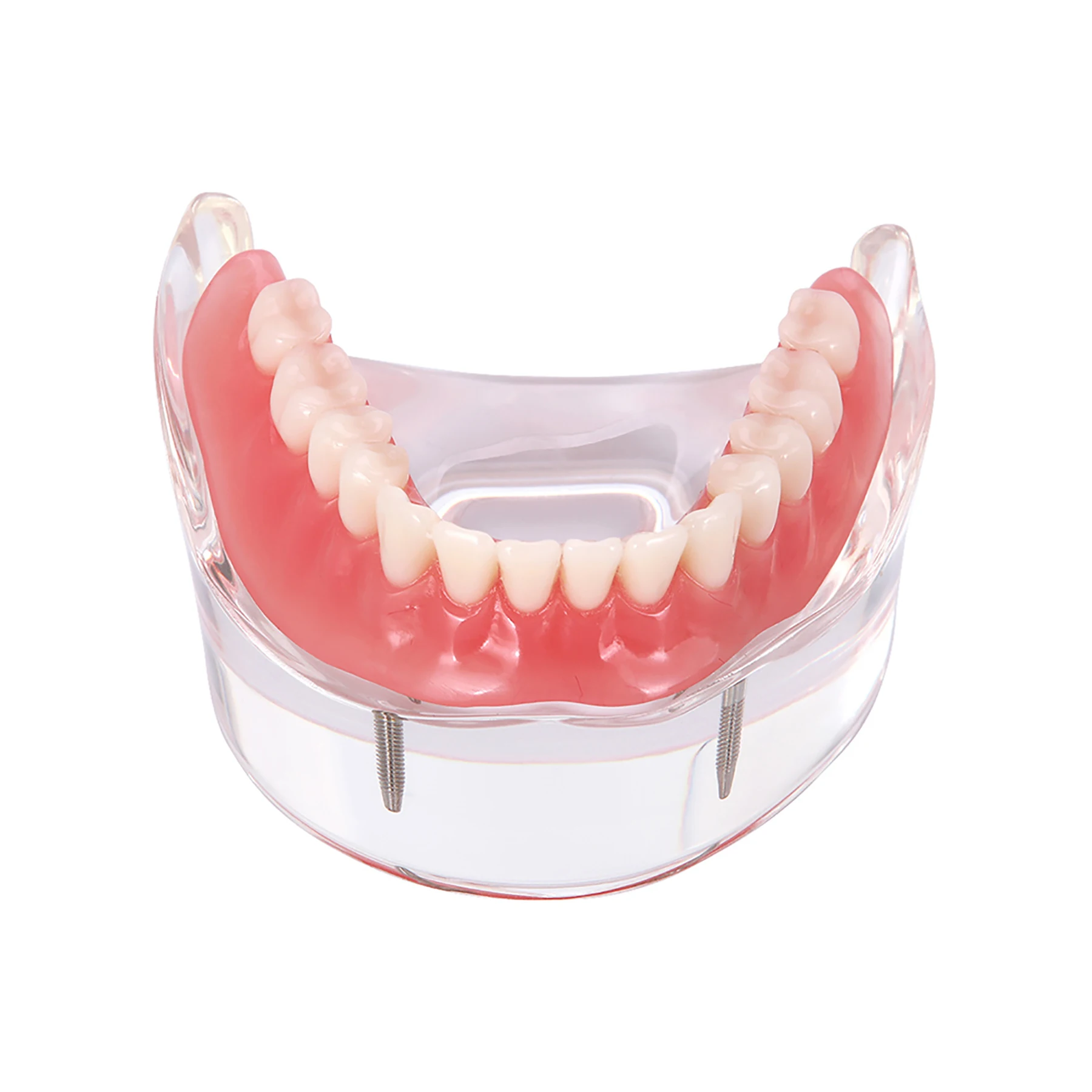 

Dental Overdenture Model with 2 Implants Inferior Study Demo Model M6002 for Dental Training