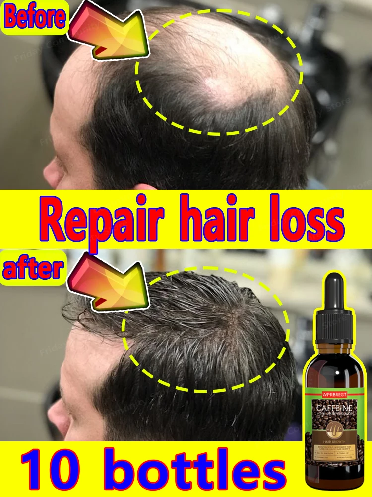 Best-selling global anti-hair loss men's and women's hair growth essence, rapid hair growth oil, natural plant extracts