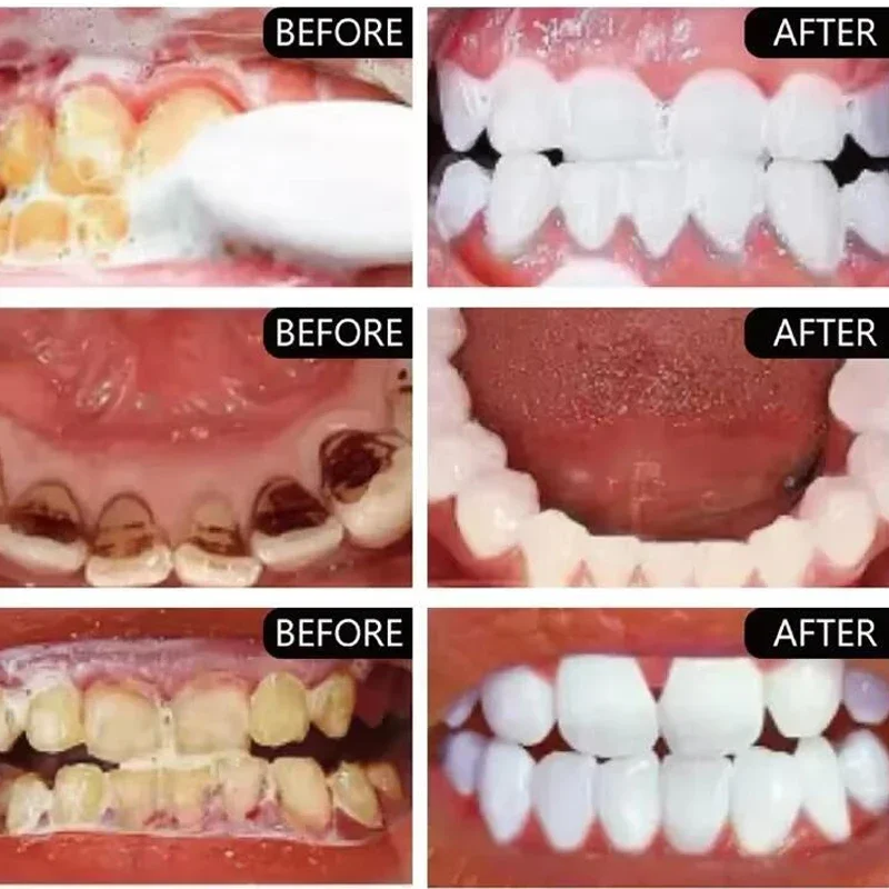 5 giorni di polvere per sbiancamento dei denti rimuovere macchie di placca calcolo dentale igiene orale pulizia alito cattivo fresco prodotti per la cura dei denti