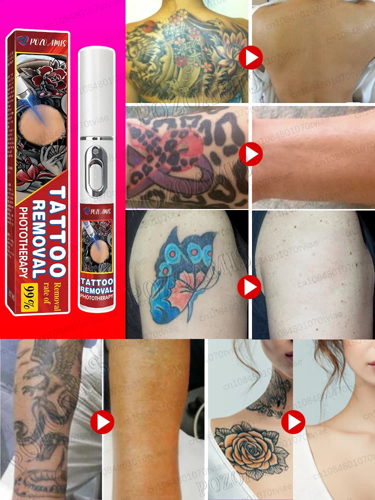 Rimozione del tatuaggio e rimozione del colore