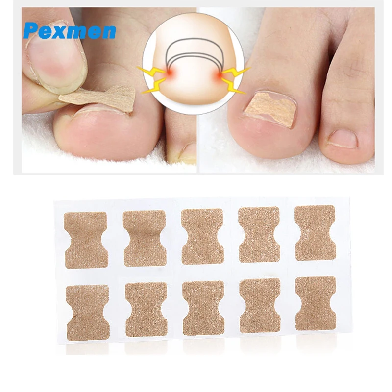 Pexmen 100/200/500/1000Pcs Ingrown Toenail Treatment No Glue Breathable Corrector Patch Painless ingrown toenail corrector