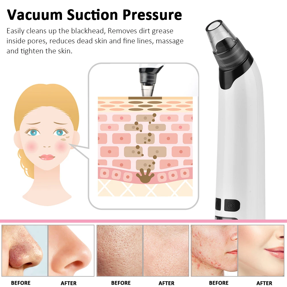 Electric Blackhead Remover Hot Compress Blackhead Remover Vacuum Suction Acne with 3 Adjustable Suction Levels & 4 Replaceable