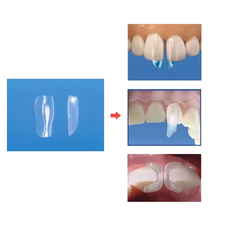 10Pcs/Box Dental Clear Matrix Bands Anterior Matrices BT Bow Matrice Front Matrices Bioclear Style Dental Restoration Materials