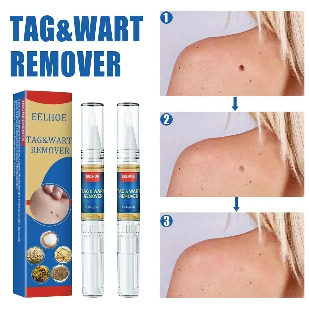 Wart Remover Pen Auto Skin Tag Mole Removal Kit Cleaning Pen Face Skin Care Body Dot Treatments Remover Beauty Health