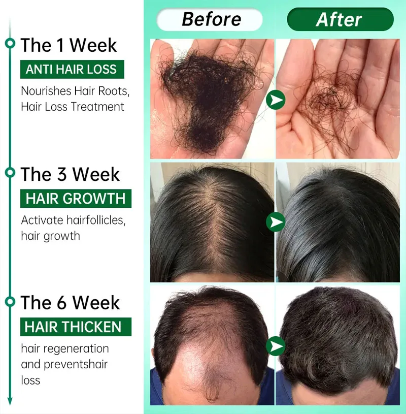 Soro rápido para o crescimento do cabelo, produtos anti-perda de crescimento do cabelo, reparação Nourish cabelo danificado, óleo para o cuidado do couro cabeludo para mulheres e homens, 7 dias