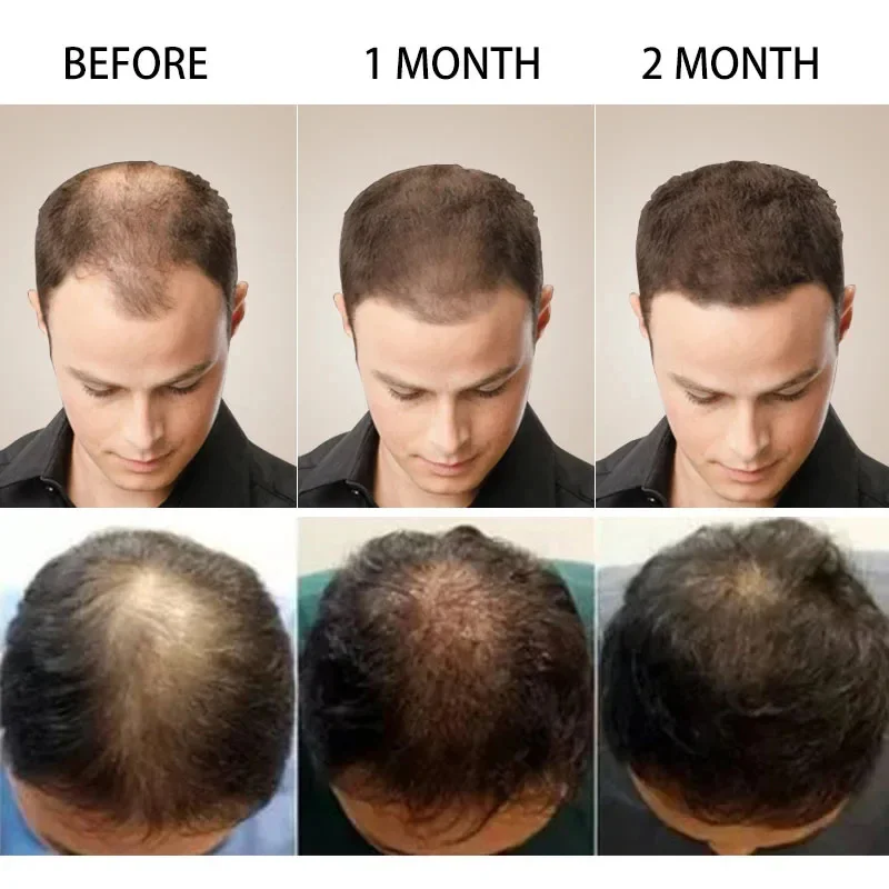 7 Dagen Snel Gember Haargroei Serum Anti-Verlies Haargroei Behandeling Etherische Olie Reparatie Beschadigd Haarwortels Haarverzorgingsproduct