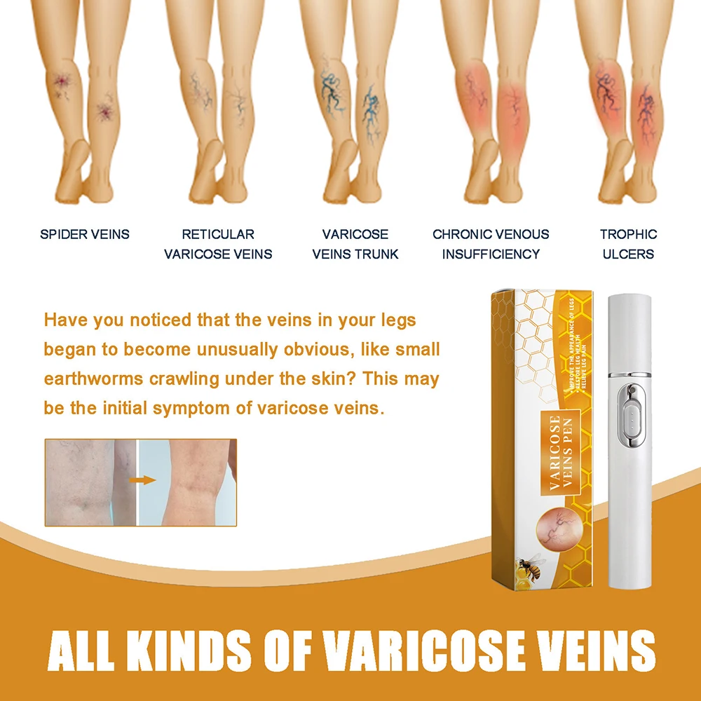 Lampshade Therapy Varicose Veins Effective Relief of Dilated Vasculitis In The Legs Phlebitis Health Improved Blood Circulation