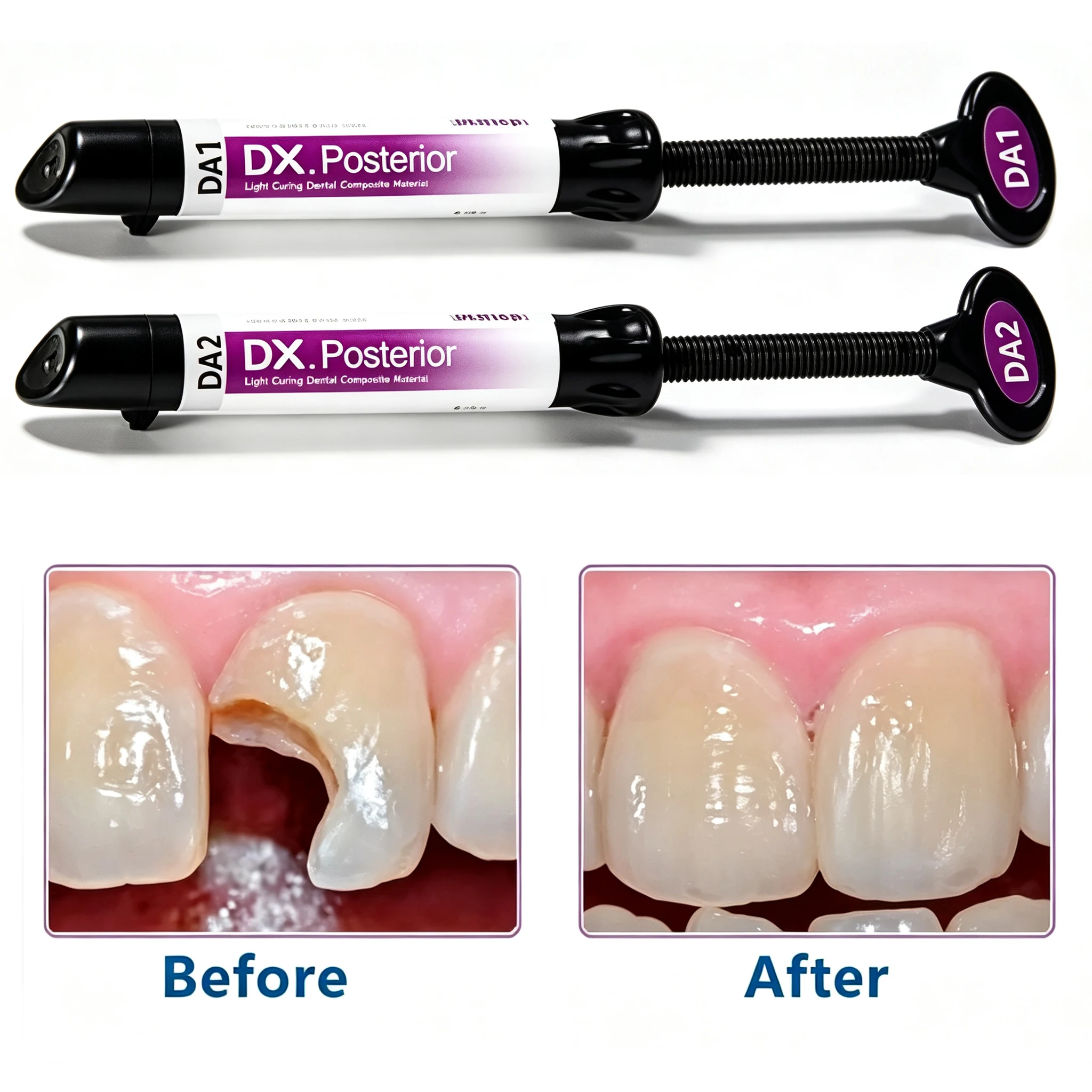 Dental Strength Composite Resin Set High Hardness Wear-resistant Posterior Teeth Filling Light Cure Composite Restoration Kit