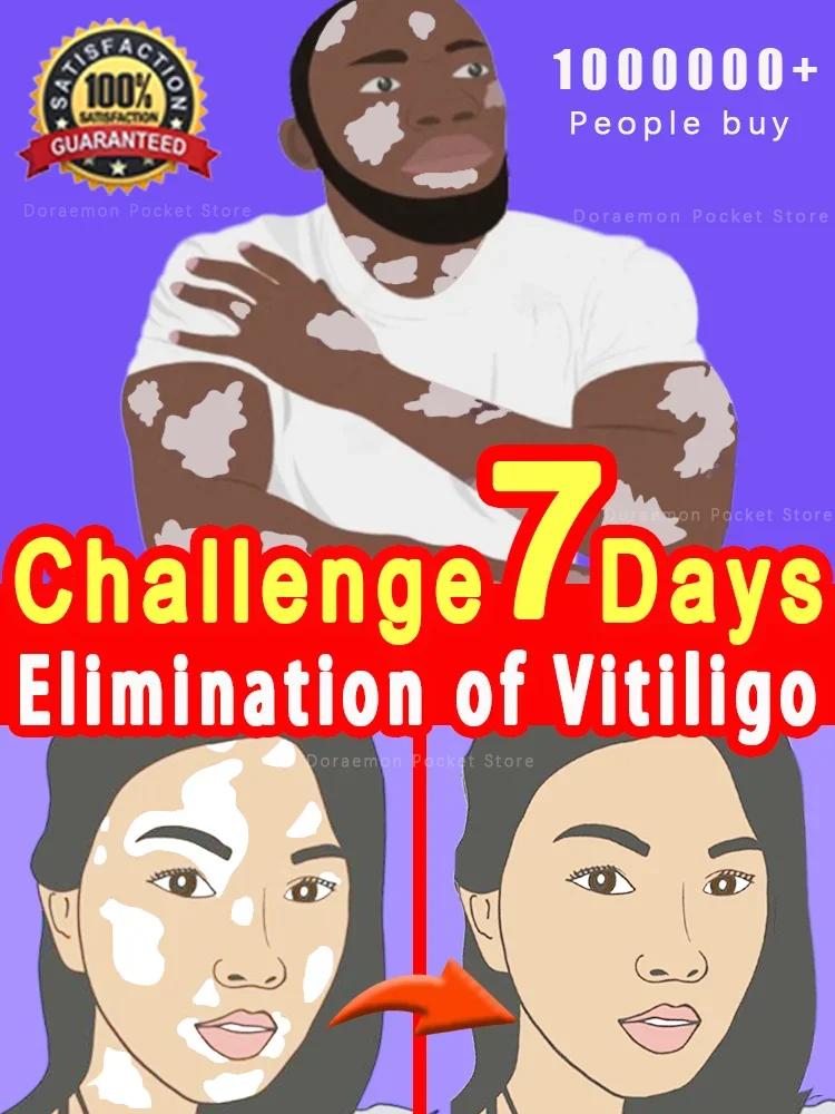 Vitiligo Treatment Cream Repair Ointment