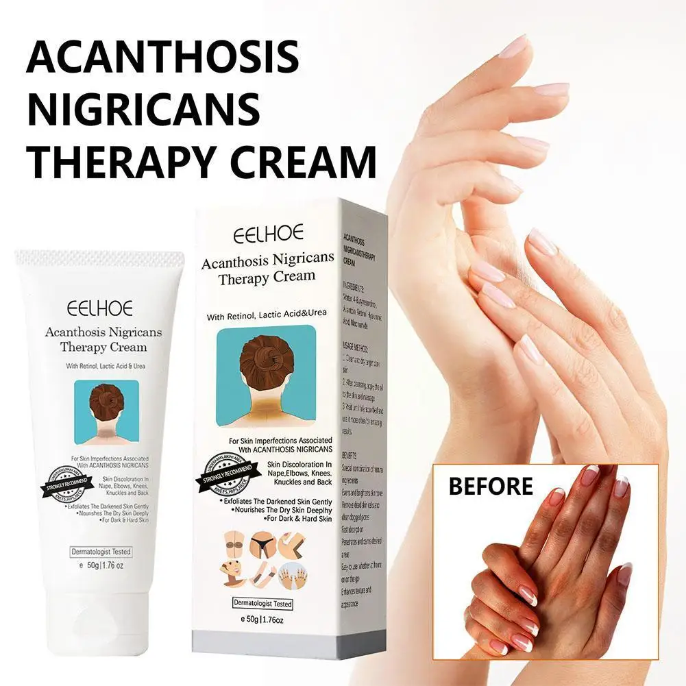 EELHOE acantosis Nigricans crema de terapia para axilas, brazos, articulación de rodilla, crema hidratante y blanqueadora negra para el cuidado corporal