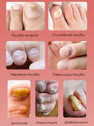 Verhéritage à Ongles Efficace R-emoval, Réparation des Champignons des Ongles