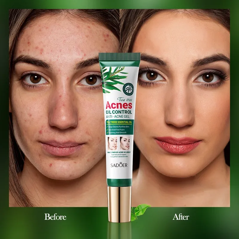 Tea Tree Acne Removing and Oil Controlling Gel Moisturizing Mild Acne Printing Gel Tea Tree Essential Oil Anti-acne Gel