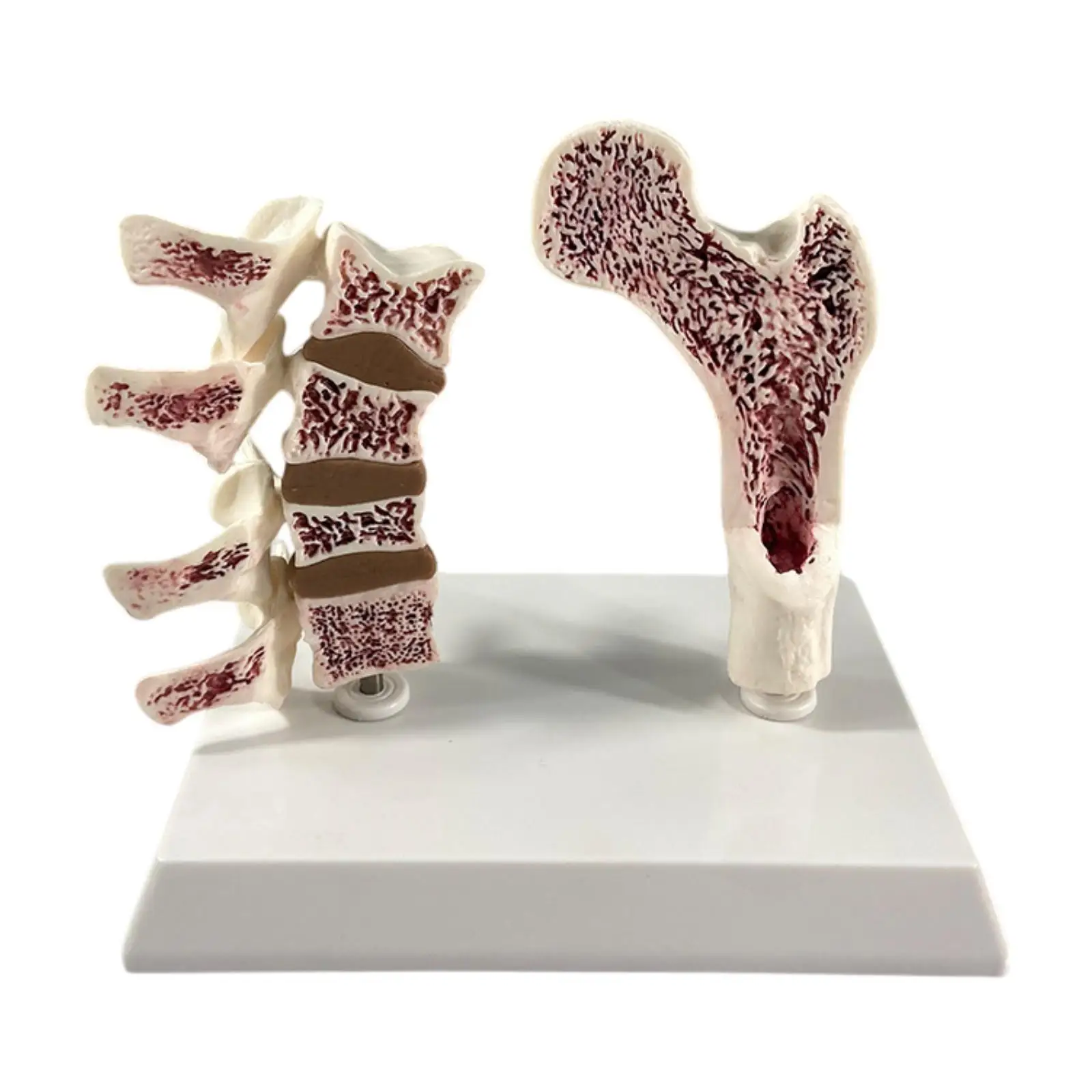 

Human Femur Osteoporosis Anatomy Model Skeleton Display for Classroom