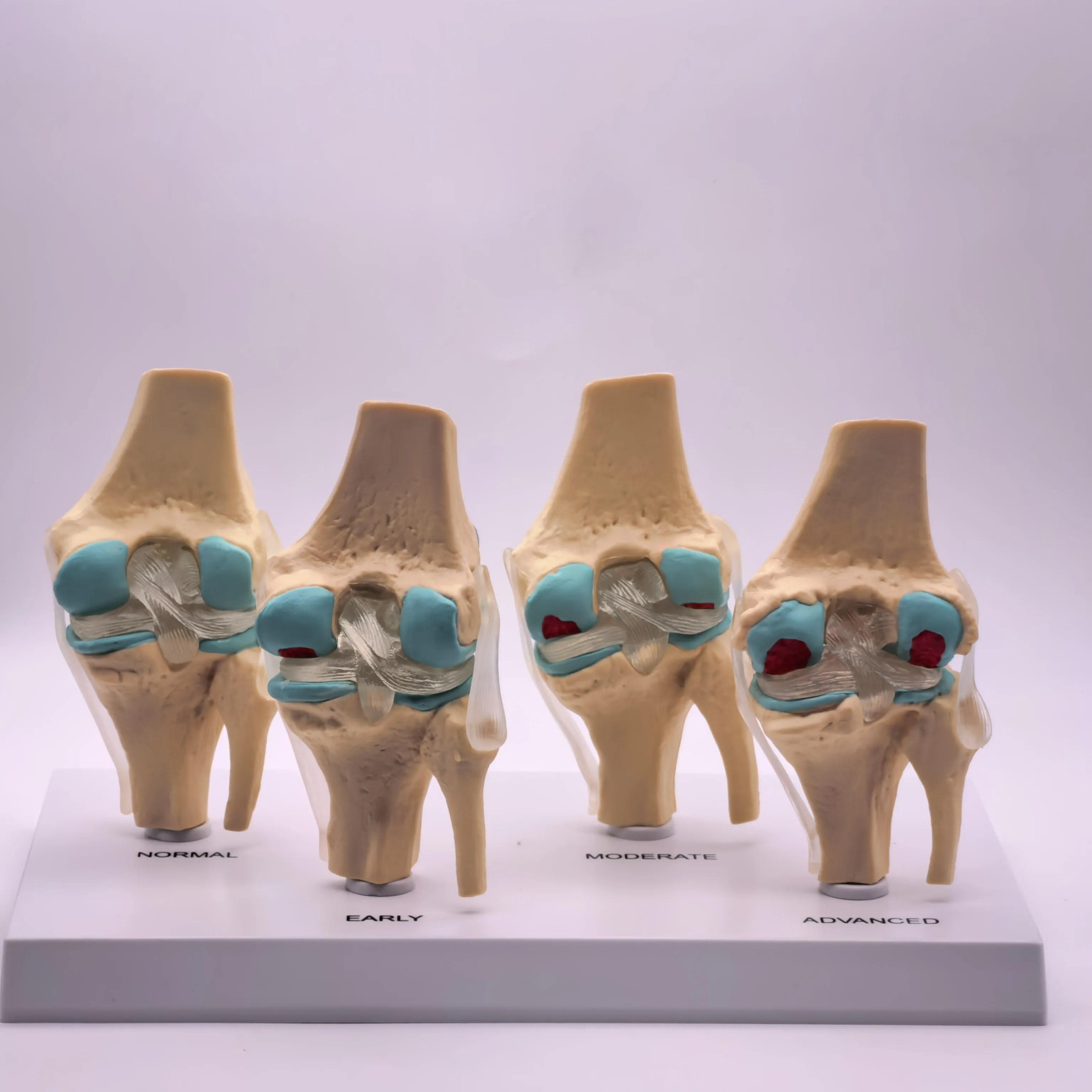 نموذج مرض مفصل الركبة التشريحي البشري المزخرف تشريح الهيكل العظمي الطبي موارد التدريس PVC #2