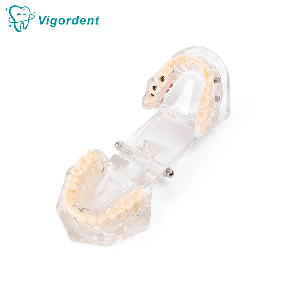 

Vigordent Dental Models Repairable Resin Models Of Diseased Teeth For Teaching And Research In Medicine And Dental Diseases