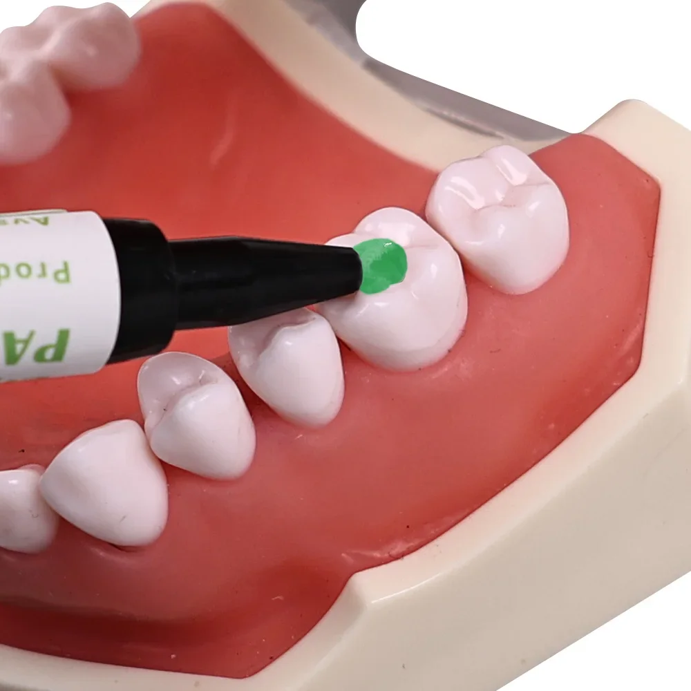 دعامة الأسنان الأخضر الغراء المواد اللاصقة تقويم الأسنان العالمي علاج الضوء لقوس أنبوب السندات لصق محفور حمض هلام طبيب الأسنان المواد