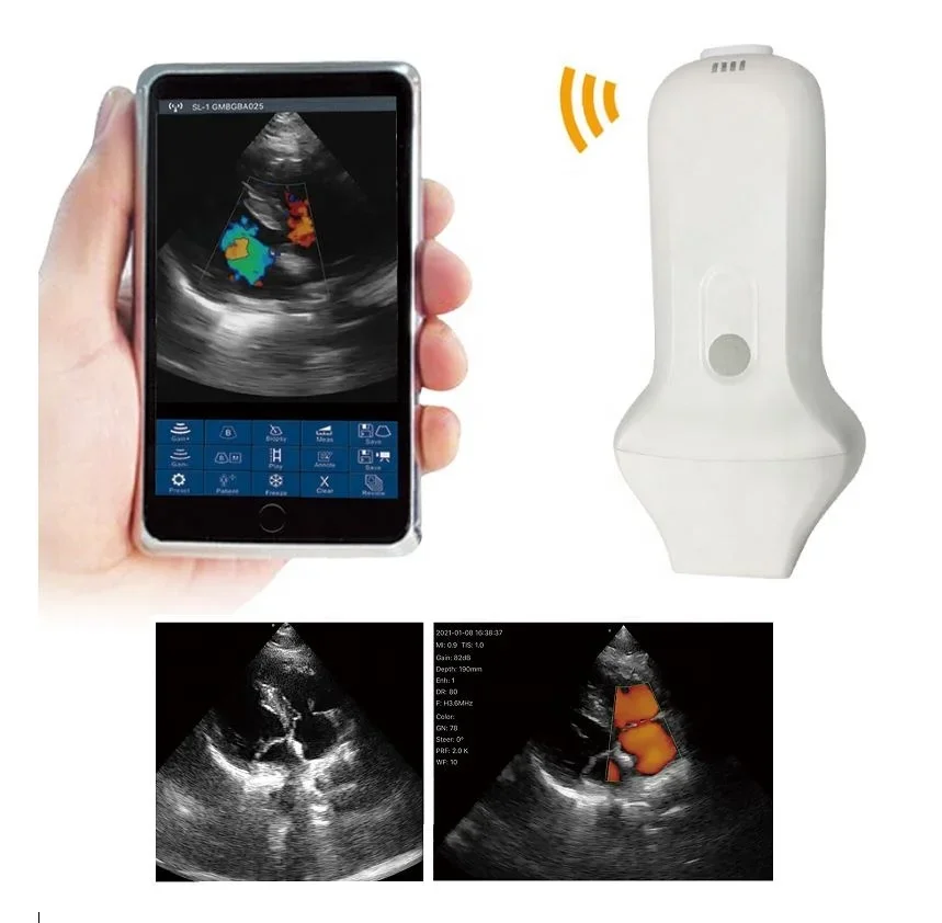 Yuvnice New Phased Array Cardiac Ultrasound Probe USB Wireless Ultrasound Scanner Probe